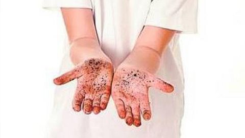 Boala mâinilor murdare – frecventă la Târgu Secuiesc